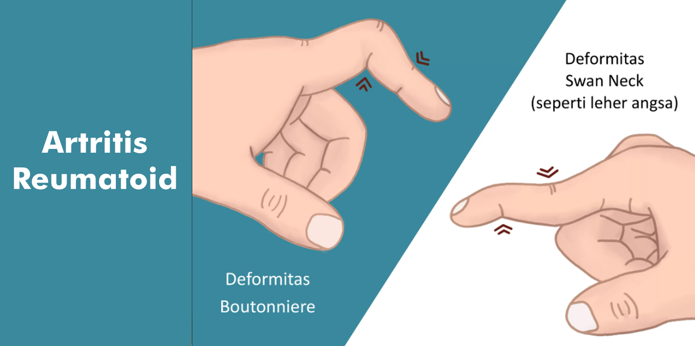 Kenali Artritis Reumatoid Tangani Sebelum Terlambat